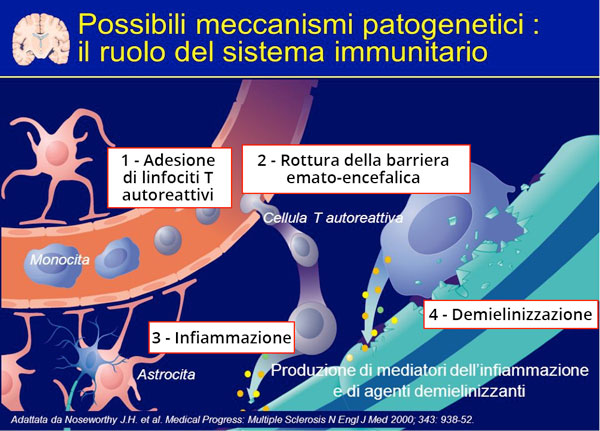 Patogenesi Sclerosi Multipla