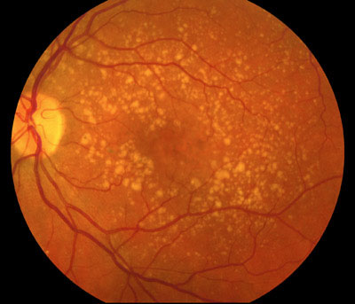 Fondo oculare che mostra le lesioni basilari: drusen (macchie giallastre della retina) e rimaneggiamenti pigmentari.